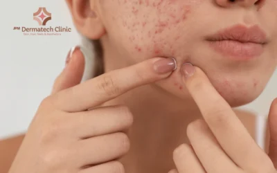 Say Goodbye to Acne & Pimples